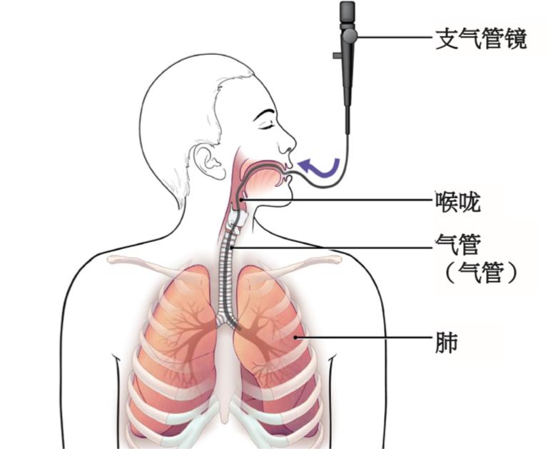 鼹鼠医疗视角下:颈椎固定患者可视喉镜与纤支镜气管插管的比较 鼹鼠医疗视角下:颈椎固定患者可视喉镜与纤支镜气管插管的比较